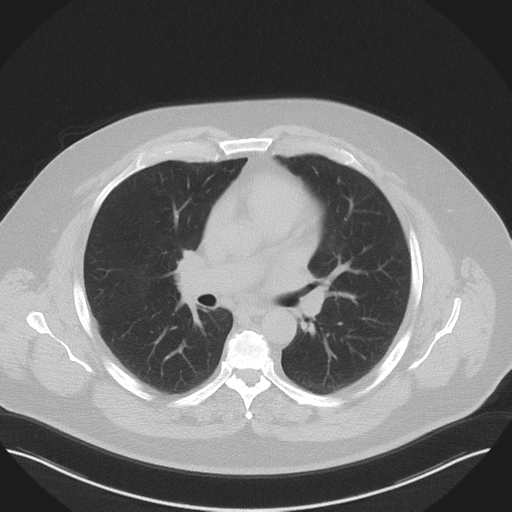 Normal HRCT (Radiopaedia 40797-43458 Axial lung window 28).png