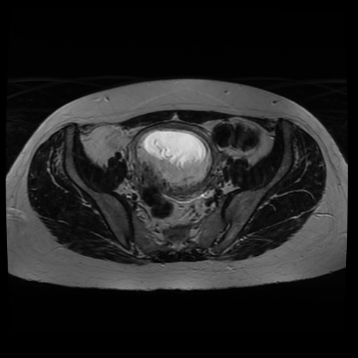 Normal MRI abdomen in pregnancy (Radiopaedia 88005-104548 Axial T2 24).jpg
