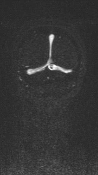 Normal MRI brain with MRV- teenager (Radiopaedia 49425-54553 Coronal MRV 210).jpg