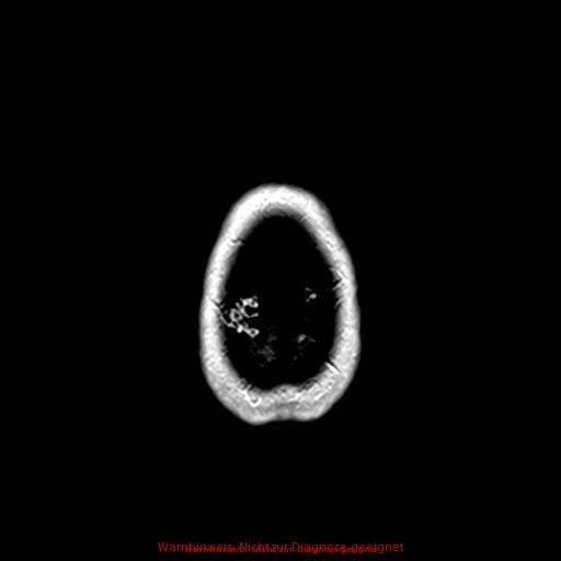 Normal adult brain MRI (non-enhanced and contrast-enhanced) (Radiopaedia 75262-86379 Axial T1 C+ 176).jpg