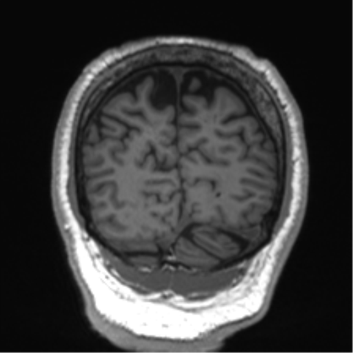 Normal brain MRI (non-focal epilepsy protocol) (Radiopaedia 53917-60040 Coronal T1 14).png