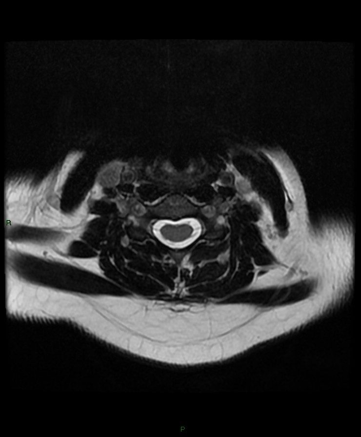 Normal cervical spine MRI (Radiopaedia 80146-93454 Axial T2 51).jpg