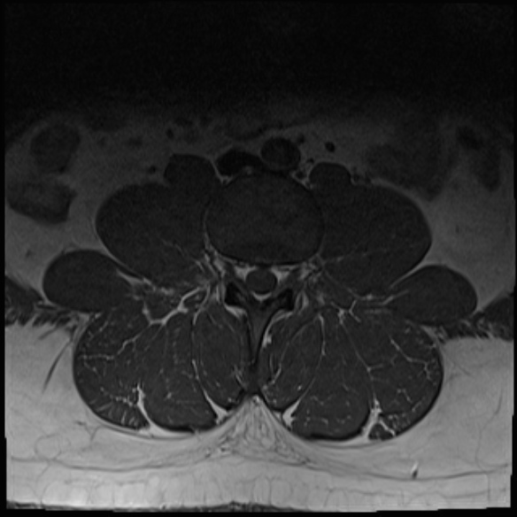 File:Normal lumbar spine MRI (Radiopaedia 47857-52609 Axial T1 6).jpg