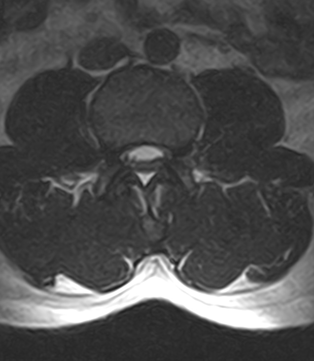 Normal lumbar spine MRI - low-field MRI scanner (Radiopaedia 40976-43699 Axial T2 51).jpg