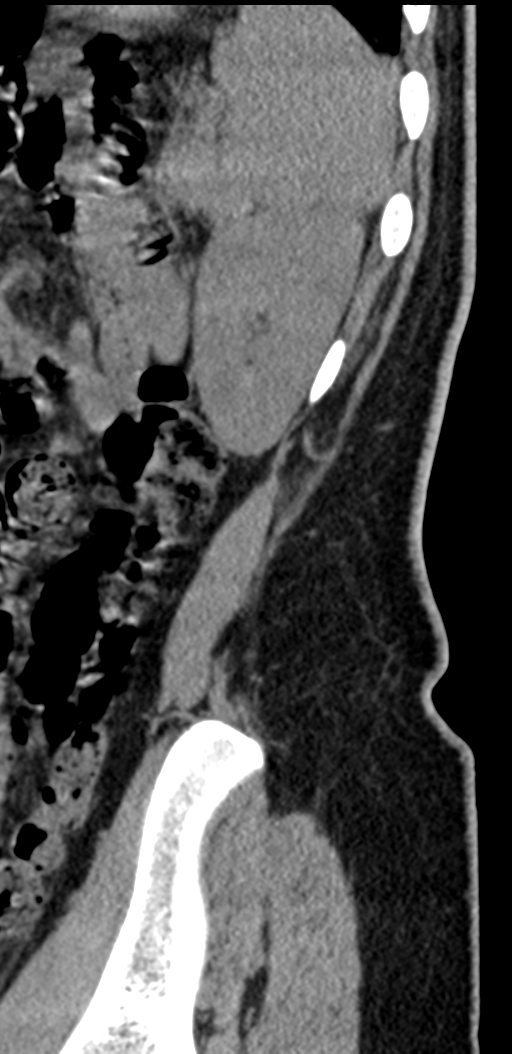 Normal lumbosacral CT (Radiopaedia 37923-39867 E 9).png