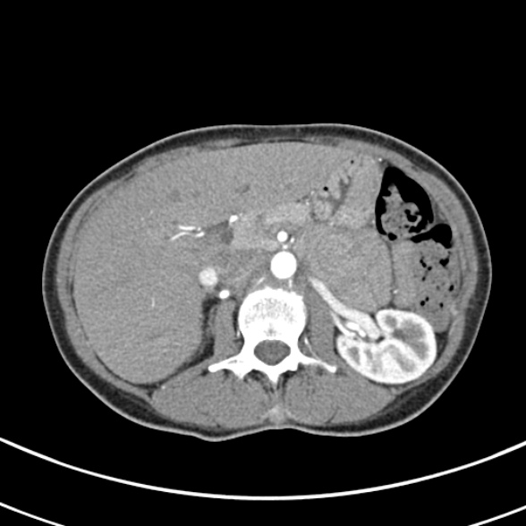 File:Normal multiphase CT liver (Radiopaedia 38026-39996 B 29).jpg