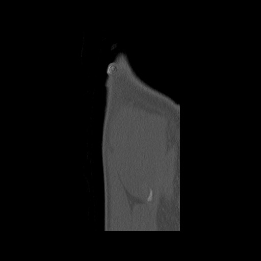 Normal pelvis (Radiopaedia 51473-57238 Sagittal bone window 146).jpg