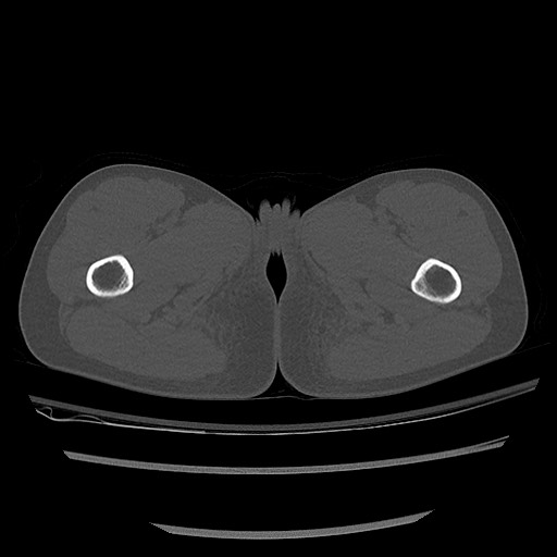 Normal pelvis CT (Radiopaedia 51471-57236 Axial bone window 107).jpg