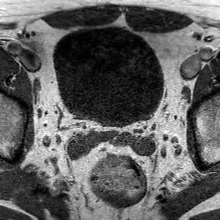File:Normal prostate (MRI) (Radiopaedia 29986-30535 Axial T1 23).jpg