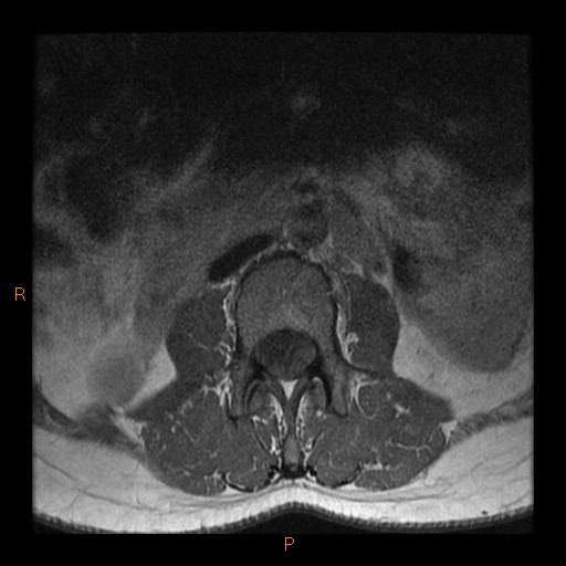 File:Normal spine MRI (Radiopaedia 77323-89408 Axial T1 2).jpg