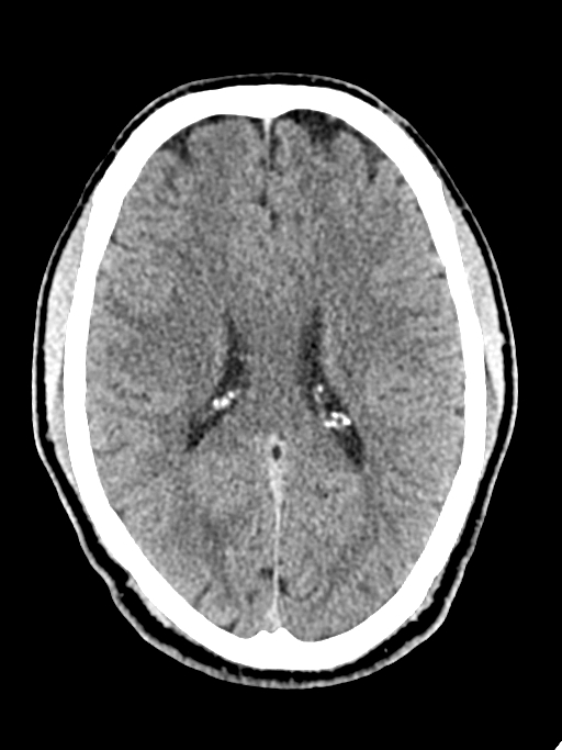 Normal trauma protocol brain and C-spine CT (Radiopaedia 83302-97709 Axial non-contrast 33).jpg