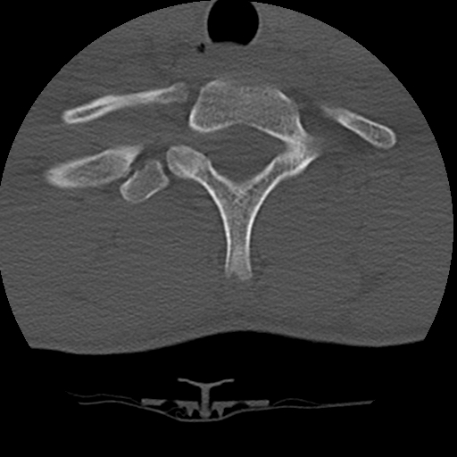 Normal trauma spine imaging (age 16) (Radiopaedia 45335-49358 Axial bone window 71).jpg