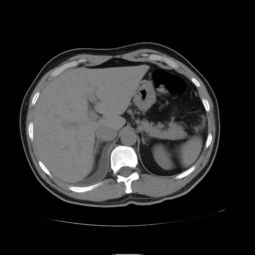 File:Obstructed kidney with perinephric urinoma (Radiopaedia 26889-27066 Axial non-contrast 4).jpg