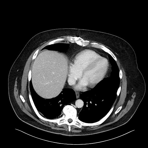 Obstructing sigmoid adenocarcinoma (Radiopaedia 58465-65619 A 17).jpg