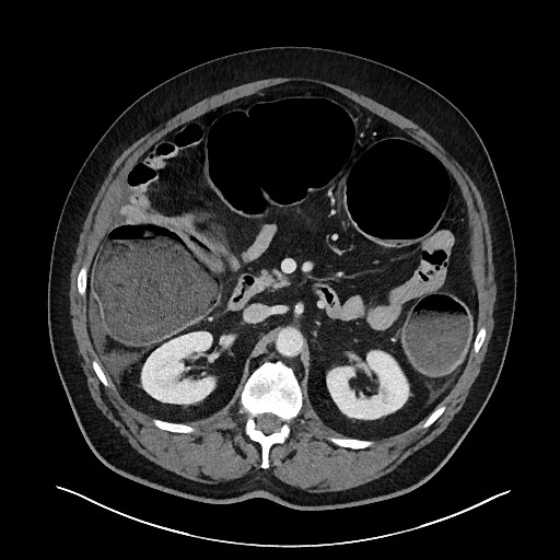 Obstructing sigmoid adenocarcinoma (Radiopaedia 58465-65619 A 62).jpg