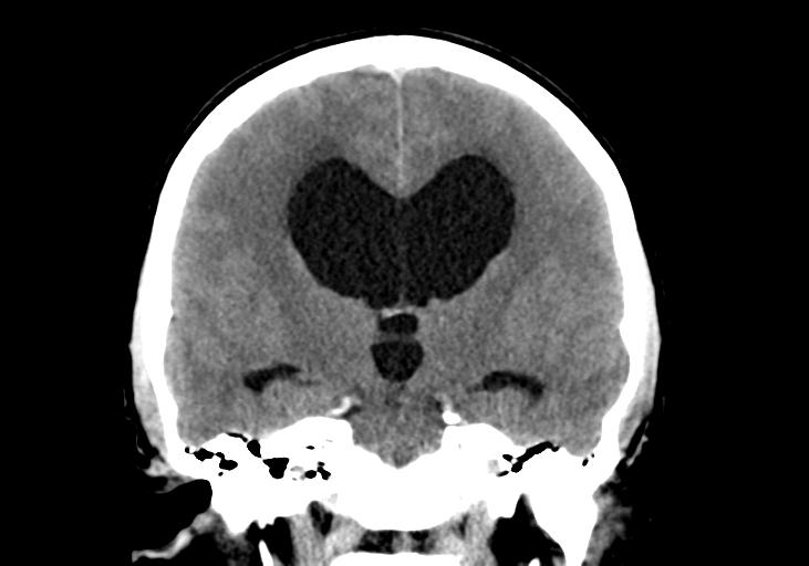 File:Obstructive hydrocephalus (Radiopaedia 30453-31119 Coronal non-contrast 20).jpg