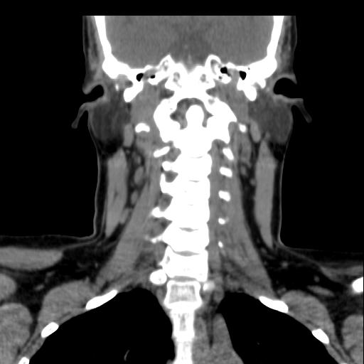 File:Obstructive sleep apnea (CT evaluation) (Radiopaedia 24304-24582 Coronal non-contrast 62).jpg