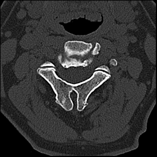 Occipital condyle fracture (type 1) (Radiopaedia 87670-104084 Axial bone window 33).jpg