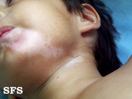 File:Vitiligo (Dermatology Atlas 18).jpg