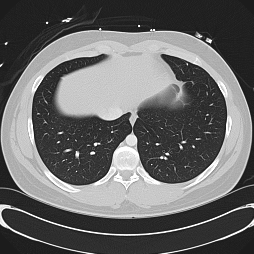File:'Bovine' aortic arch (Radiopaedia 33554-34637 Axial lung window 48).png