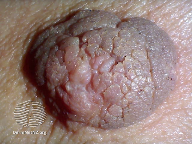 (DermNet NZ nipple-papillomatosis-02).jpg
