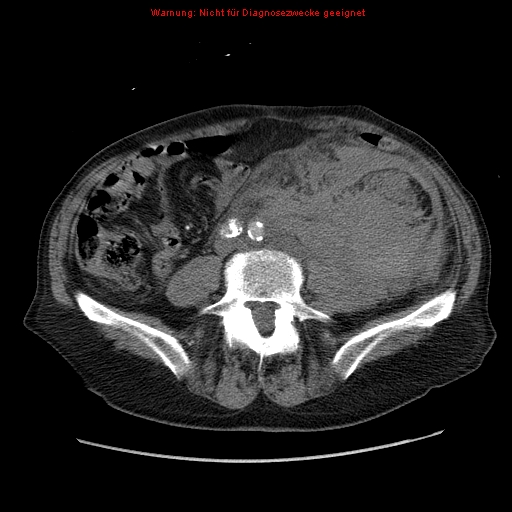 File:Abdominal aortic aneurysm- extremely large, ruptured (Radiopaedia 19882-19921 Axial C+ arterial phase 48).jpg