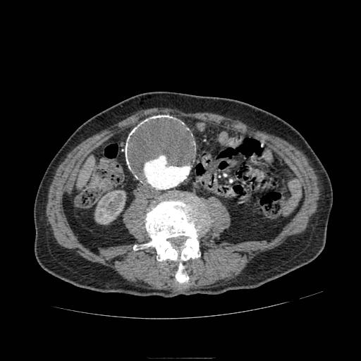 Abdominal aortic aneurysm (Radiopaedia 13341-13340 Axial C+ arterial phase 115).jpg