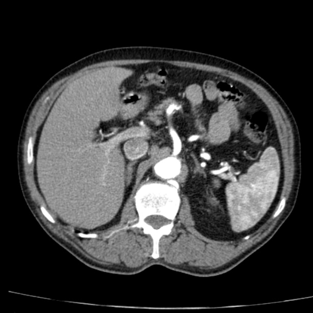 Abdominal aortic aneurysm (Radiopaedia 29248-29660 Axial C+ arterial phase 25).jpg