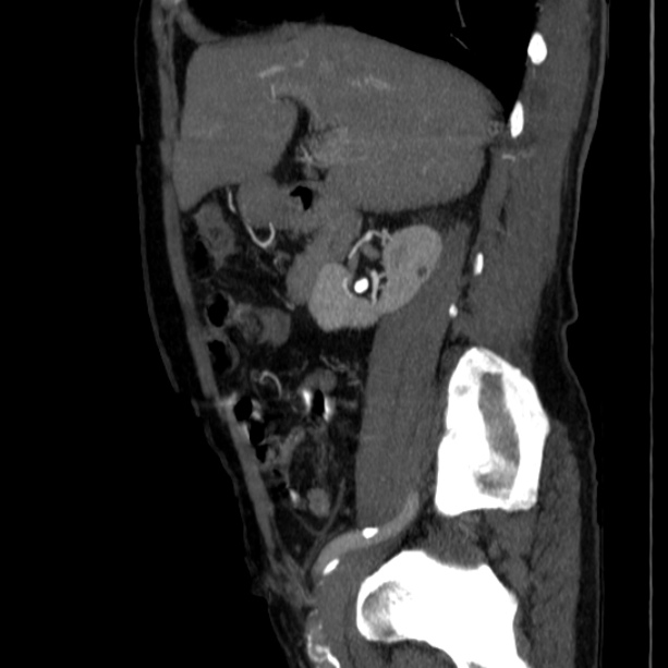 Abdominal aortic aneurysm (Radiopaedia 29248-29660 Sagittal C+ arterial phase 17).jpg