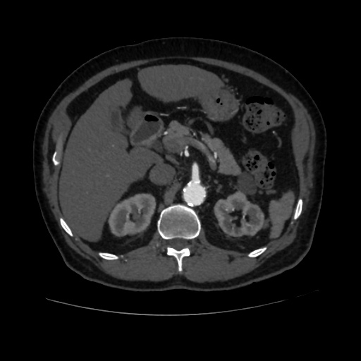 File:Abdominal aortic aneurysm (Radiopaedia 57318-64259 Axial C+ arterial phase 23).jpg