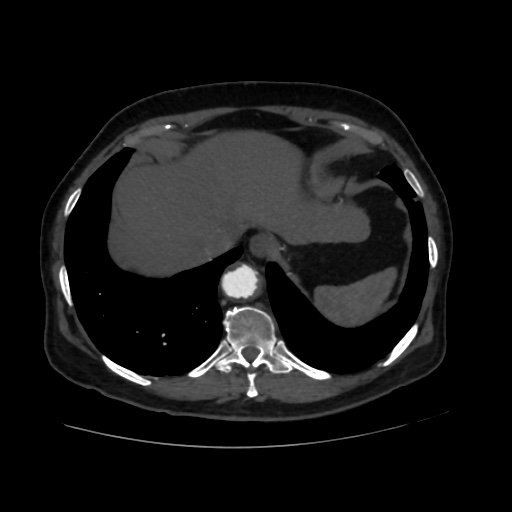 File:Abdominal aortic aneurysm (Radiopaedia 57318-64259 Axial C+ arterial phase 8).jpg