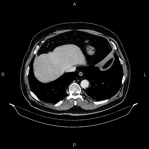 Abdominal aortic aneurysm (Radiopaedia 83094-97462 Axial renal cortical phase 63).jpg