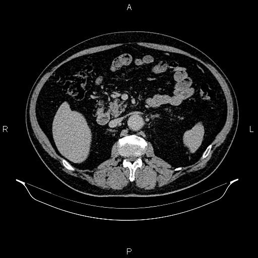 Abdominal aortic aneurysm (Radiopaedia 83094-97462 Axial renal excretory phase 42).jpg
