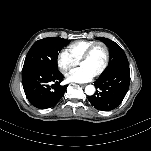 Abdominal aortic aneurysm (Radiopaedia 83581-98689 Axial C+ arterial phase 4).jpg