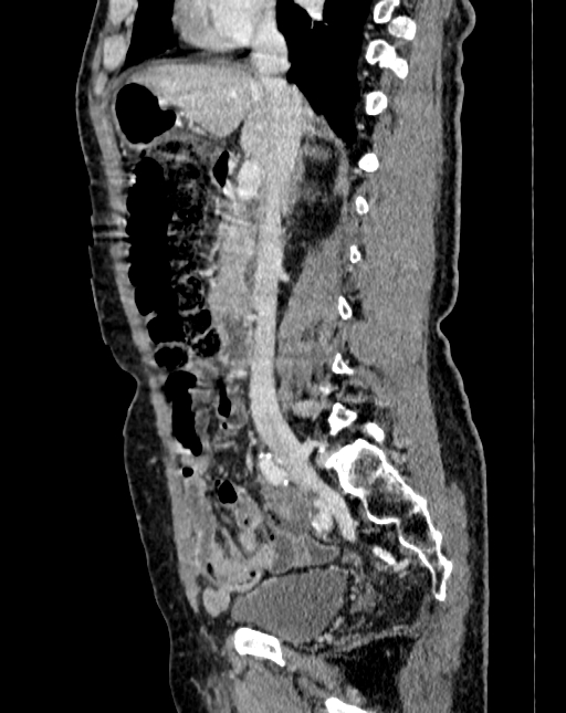 Abdominal aortic aneurysm (Radiopaedia 83581-98689 Sagittal C+ portal venous phase 27).jpg