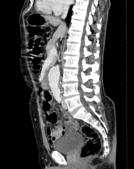 Abdominal aortic aneurysm (Radiopaedia 83581-98689 Sagittal C+ portal venous phase 45).jpg