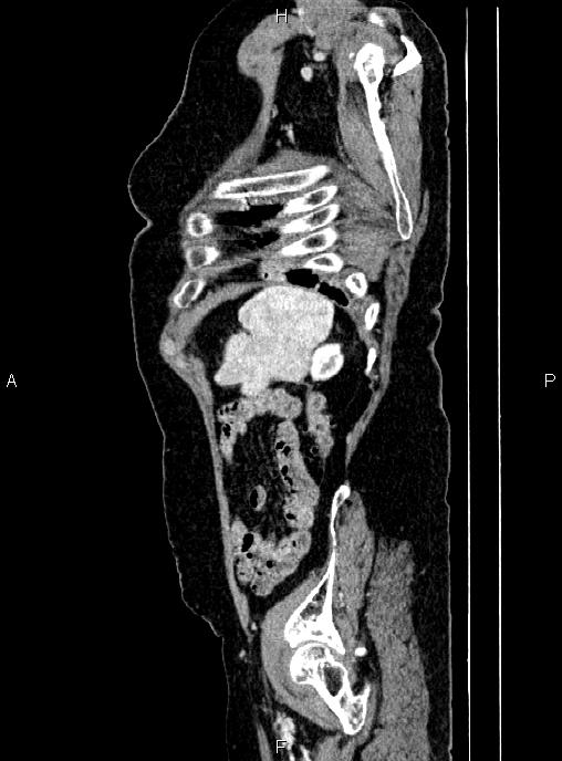 Abdominal aortic aneurysm (Radiopaedia 85063-100606 Sagittal C+ arterial phase 71).jpg