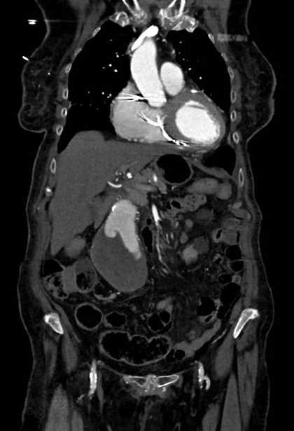 Abdominal aortic aneurysm with thrombus fissuration (Radiopaedia 73192-83919 Coronal C+ arterial phase 21).jpg