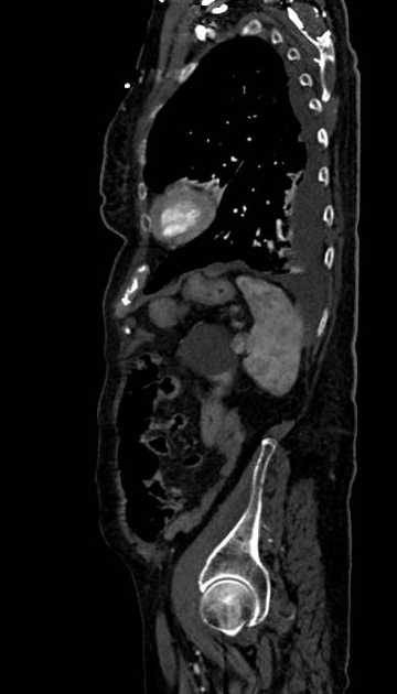 Abdominal aortic aneurysm with thrombus fissuration (Radiopaedia 73192-83919 Sagittal C+ arterial phase 23).jpg