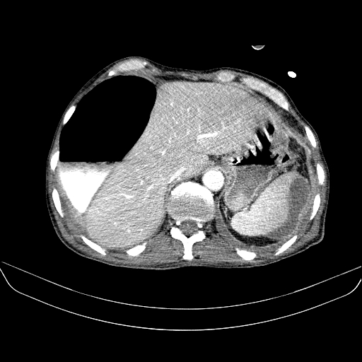 File:Abdominal collection due to previous cecal perforation (Radiopaedia 80831-94320 Axial C+ portal venous phase 36).jpg
