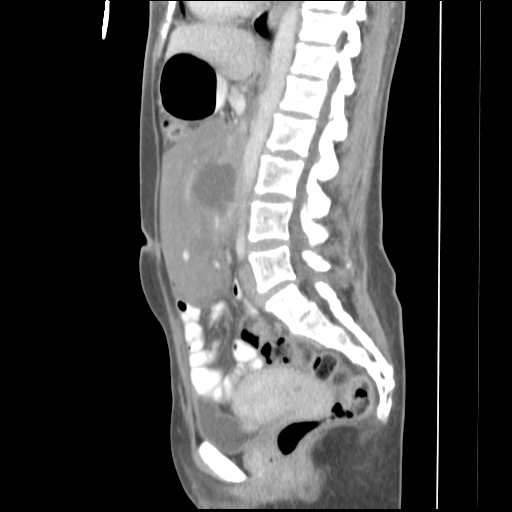 File:Abdominal desmoid tumor (Radiopaedia 41007-43740 Coronal C+ portal venous phase 1).png