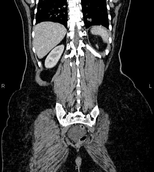 File:Abdominal lymphoma with sandwich sign (Radiopaedia 84378-99704 Coronal C+ portal venous phase 58).jpg