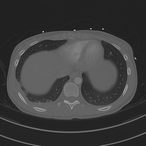 File:Abdominal multi-trauma - devascularised kidney and liver, spleen and pancreatic lacerations (Radiopaedia 34984-36486 I 67).png