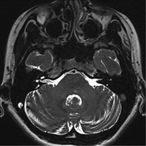 Abducens nerve palsy (Radiopaedia 51069-56648 Axial T2 fat sat 24).png