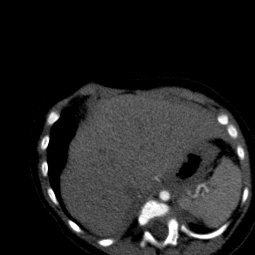 File:Aberrant left pulmonary artery (pulmonary sling) (Radiopaedia 42323-45435 Axial C+ CTPA 43).jpg