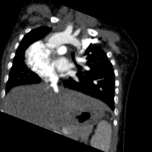 File:Aberrant left pulmonary artery (pulmonary sling) (Radiopaedia 42323-45435 Coronal C+ CTPA 14).jpg