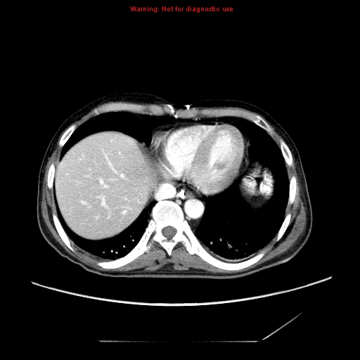 Aberrant right subclavian artery (Radiopaedia 9379-10071 Axial C+ arterial phase 51).jpg