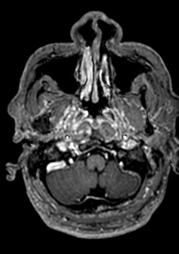 File:Accessory middle cerebral artery (Radiopaedia 73114-83828 Axial T1 C+ 171).jpg