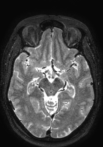 File:Accessory middle cerebral artery (Radiopaedia 73114-83828 Axial T2 104).jpg
