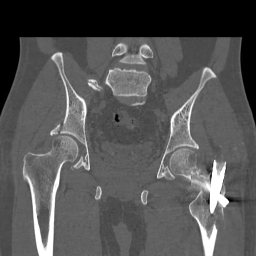 Acetabular and ilial fractures (Radiopaedia 59084-66378 Coronal bone window 31).jpg